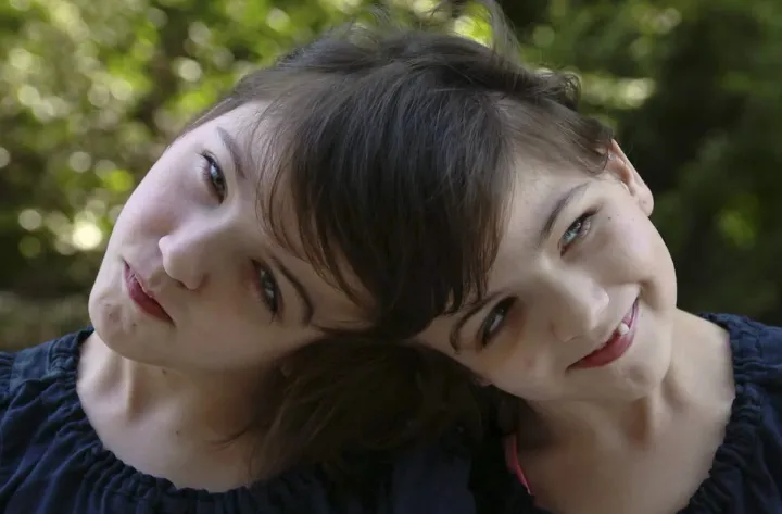 سرگذشت عجیب دوقلوهای به هم چسبیده کانادایی